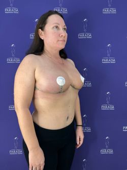 podtyazhka grudi %E2%80%94 mastopeksiya 3