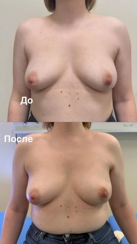 profilakticheskaya mastektomiya