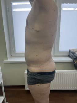 Подтяжка тела (Body Lift) 113 abdominoplastika. bodilift. kompleksnye operaczii posle snizheniya vesa 7