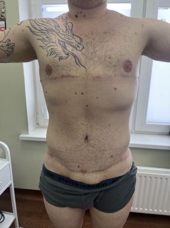 Подтяжка тела (Body Lift) 90 abdominoplastika. bodilift. kompleksnye operaczii posle snizheniya vesa 5
