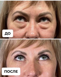 blefaroplastika 2 10