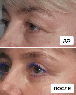 blefaroplastika 2 5