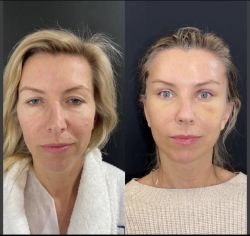 blefaroplastika 2 7
