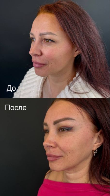 endoskopicheskaya podtyazhka 5