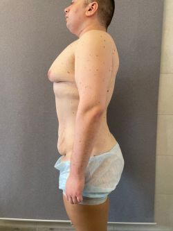 Подтяжка тела (Body Lift) 109 abdominoplastika. bodilift. kompleksnye operaczii posle snizheniya vesa 3