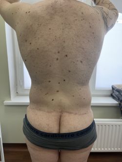 Подтяжка тела (Body Lift) 114 abdominoplastika. bodilift. kompleksnye operaczii posle snizheniya vesa 8