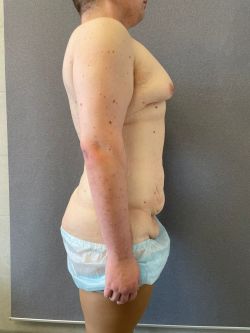Подтяжка тела (Body Lift) 110 abdominoplastika. bodilift. kompleksnye operaczii posle snizheniya vesa 4