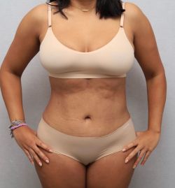abdominoplastika 2