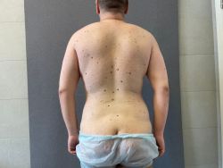 Подтяжка тела (Body Lift) 108 abdominoplastika. bodilift. kompleksnye operaczii posle snizheniya vesa 2