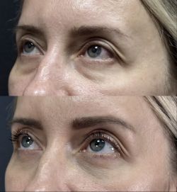 blefaroplastika 2 11
