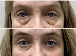 blefaroplastika 2 12
