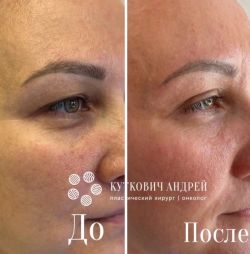 blefaroplastika 3 2