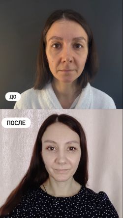 endoskopicheskaya podtyazhka 6