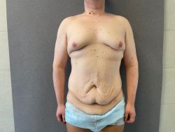 Подтяжка тела (Body Lift) 107 abdominoplastika. bodilift. kompleksnye operaczii posle snizheniya vesa 1