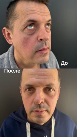 blefaroplastika 2 13