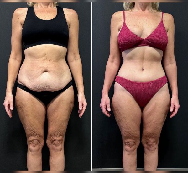 abdominoplastika 8