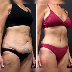 abdominoplastika 6