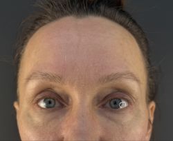 blefaroplastika 1 4