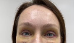 blefaroplastika 1 1