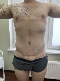 Подтяжка тела (Body Lift) 112 abdominoplastika. bodilift. kompleksnye operaczii posle snizheniya vesa 6