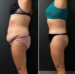 abdominoplastika 5
