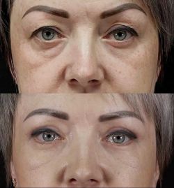 blefaroplastika 2 15 11b0efee