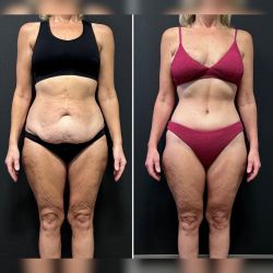 abdominoplastika 8 133eca9e