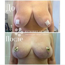 umenshenie grudi %E2%80%94 redukczionnaya mammoplastika 1 16ab8617