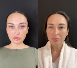 blefaroplastika 2 3 17568e46