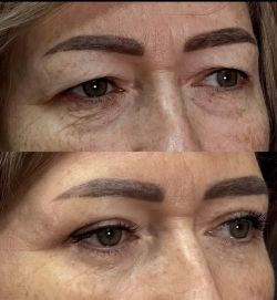 blefaroplastika 2 14 1eec5684