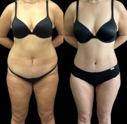 abdominoplastika 1 3d2e3af4
