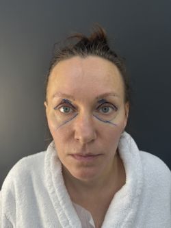 blefaroplastika 1 3 43301611