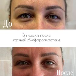 blefaroplastika 3 1 43f01128