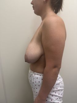 umenshenie grudi %E2%80%94 redukczionnaya mammoplastika 15 56e7f39f