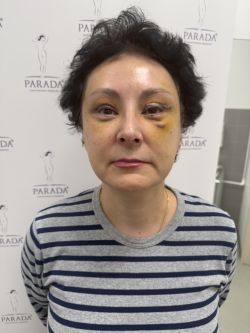 blefaroplastika 1 2 5ec9d69e