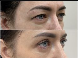 blefaroplastika 2 6 78846e39