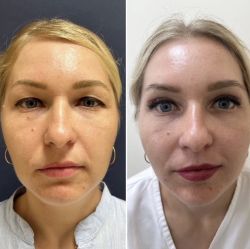 blefaroplastika 2 17 85b80d8c