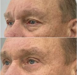 blefaroplastika 2 1 870b0108