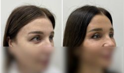 blefaroplastika 2 16 878ad647