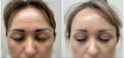 blefaroplastika 2 9 897fd8b3