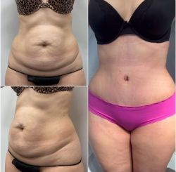 abdominoplastika 7 8b092d07