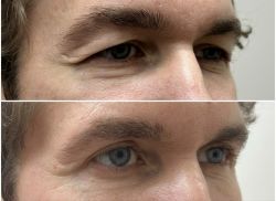 blefaroplastika 2 2 95683479
