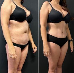 abdominoplastika 3 9b2d435e