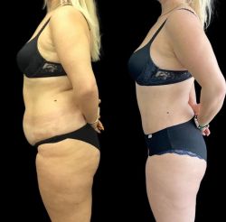 abdominoplastika 9 a8827cd0