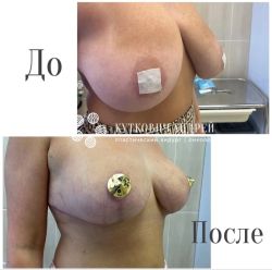 umenshenie grudi %E2%80%94 redukczionnaya mammoplastika 6 a82c27f5
