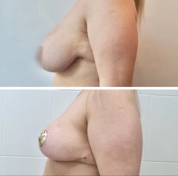 umenshenie grudi %E2%80%94 redukczionnaya mammoplastika 11 ae77dc1f