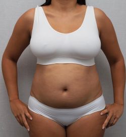 abdominoplastika 4 af16225f