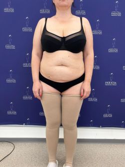 abdominoplastika 111 2 cbc0a05c