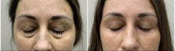 blefaroplastika 2 8 fb5b422f